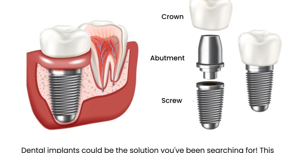 Restore Function and Beauty with the Best Dental Implants in Bangalore